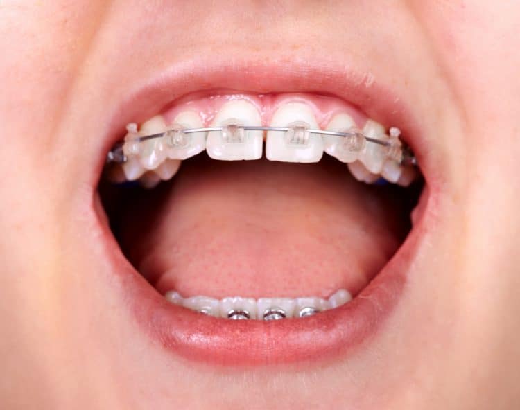 Can 7-Year-Olds Get Braces? - 7 Year Olds